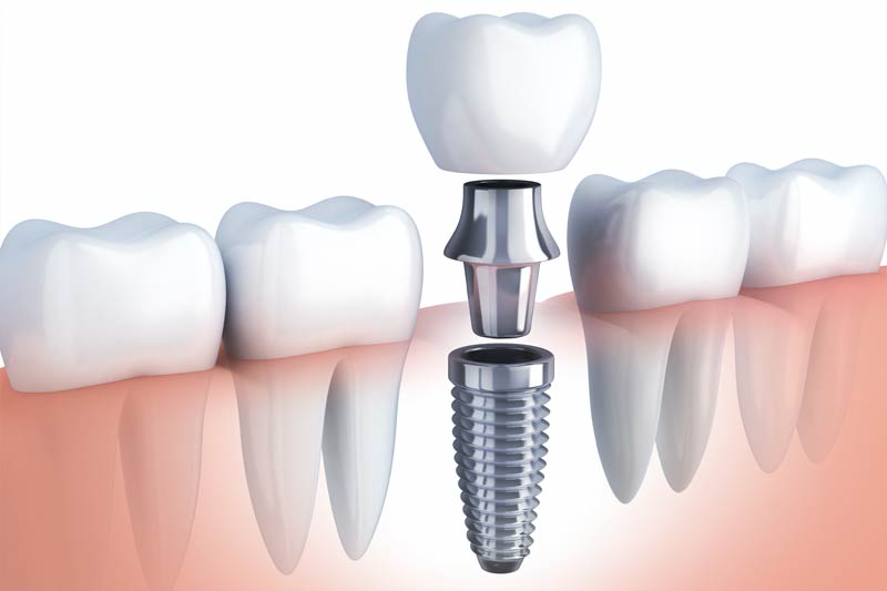 Encino Total Dentistry Special Offer